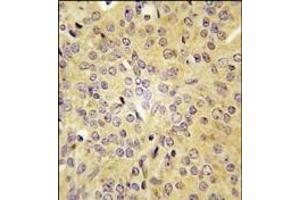 Formalin-fixed and paraffin-embedded human prostata carcinoma tissue reacted with LARS antibody (C-term), which was peroxidase-conjugated to the secondary antibody, followed by DAB staining.