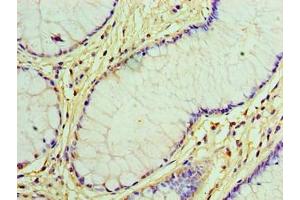 Immunohistochemistry of paraffin-embedded human colon cancer using ABIN7153892 at dilution of 1:100 (GCKR Antikörper  (AA 1-625))