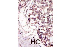 Formalin-fixed and paraffin-embedded human hepatocellular carcinoma tissue reacted with RYK polyclonal antibody  , which was peroxidase-conjugated to the secondary antibody, followed by DAB staining.