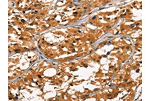 The image on the left is immunohistochemistry of paraffin-embedded Human thyroid cancer tissue using ABIN7190457(DEFA1/3 Antibody) at dilution 1/30, on the right is treated with synthetic peptide.