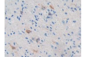DAB staining on IHC-P; Samples: Human Glioma Tissue (PRKAB2 Antikörper  (AA 17-260))