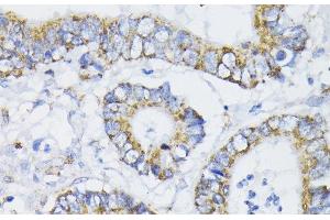 Immunohistochemistry of paraffin-embedded Human colon carcinoma using PDHA1 Polyclonal Antibody at dilution of 1:200 (40x lens). (PDHA1 Antikörper)