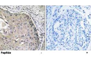 Immunohistochemistry analysis of paraffin-embedded human lung carcinoma tissue, using AOX1 polyclonal antibody .