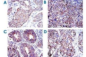 Immunohistochemical analysis of paraffin-embedded human breast cancer (A), human cervical cancer (B), human rectum cancer (C) and human lung cancer (D) tissues using AIFM1 monoclonal antibody, clone 4E7  with DAB staining. (AIF Antikörper)