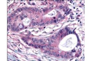 Affinity Purified Plk1 pT210 was used at a 1:200 dilution to detect Plk1 by immunohistochemistry in human colon carcinoma tumor tissue. (PLK1 Antikörper  (pThr210))