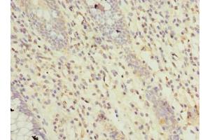 Immunohistochemistry of paraffin-embedded human colon cancer using ABIN7167492 at dilution of 1:100