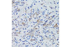 Immunohistochemistry of paraffin-embedded human uterine cancer using USO1 antibody (ABIN1875291) at dilution of 1:100 (40x lens). (USO1 Antikörper)