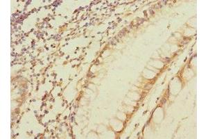 Immunohistochemistry of paraffin-embedded human colon cancer using ABIN7160425 at dilution of 1:100 (MPZL2 Antikörper  (AA 30-140))