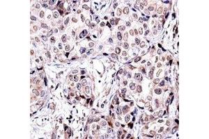 SIRT6 antibody immunohistochemistry analysis in formalin fixed and paraffin embedded human breast carcinoma. (SIRT6 Antikörper  (AA 276-305))