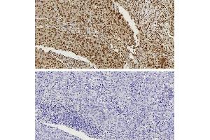 CTCF antibody (pAb) tested by Immunohistochemistry Nuclear staining pattern is detected in Formalin-fixed, paraffin-embedded tissue sections from human breast carcinoma.