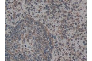 Detection of GLG1 in Human Skin cancer Tissue using Polyclonal Antibody to Golgi Glycoprotein 1 (GLG1) (GLG1 Antikörper  (AA 1048-1145))