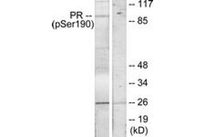 Immunohistochemistry analysis of paraffin-embedded human breast carcinoma, using Progesterone Receptor (Phospho-Ser190) Antibody. (Progesterone Receptor Antikörper  (pSer190))