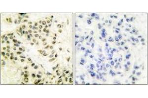 Immunohistochemistry analysis of paraffin-embedded human breast carcinoma tissue, using DNA-PK Antibody. (PRKDC Antikörper  (AA 4061-4110))