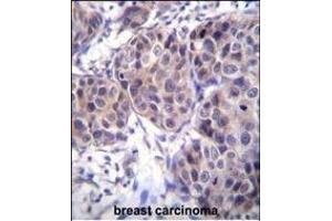 DVL3 Antibody (C-term) (ABIN655969 and ABIN2845354) immunohistochemistry analysis in formalin fixed and paraffin embedded human breast carcinoma followed by peroxidase conjugation of the secondary antibody and DAB staining. (DVL3 Antikörper  (C-Term))