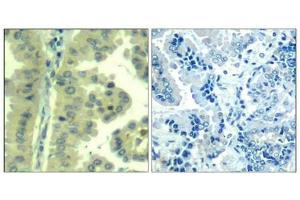 Immunohistochemical analysis of paraffin-embedded human lung carcinoma tissue using eIF4G(Ab-1232) Antibody(left) or the same antibody preincubated with blocking peptide(right). (EIF4G1 Antikörper)