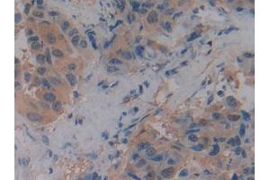 IHC-P analysis of Human Breast cancer Tissue, with DAB staining. (SLC9A3R2 Antikörper  (AA 56-337))