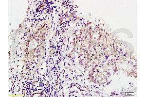 Formalin-fixed and human breast carcinoma tissue labeled with Anti-MMS19 Polyclonal Antibody, Unconjugated (ABIN1387802) at 1:200 followed by conjugation to the secondary antibody and DAB staining (MMS19 Antikörper  (AA 851-950))