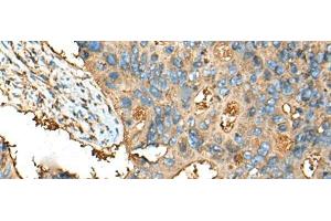 Immunohistochemistry of paraffin-embedded Human colorectal cancer tissue using CEACAM8 Polyclonal Antibody at dilution of 1:30(x200) (CEACAM8 Antikörper)