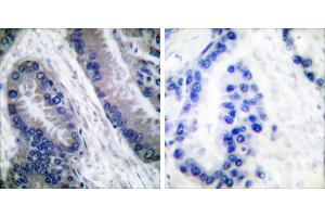 Cl-peptide - +Immunohistochemical analysis of paraffin-embedded human lung carcinoma tissue, using Caspase 1 (Cleaved-Asp210) antibody. (Caspase 1 Antikörper  (Cleaved-Asp210))