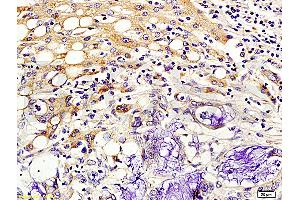 Formalin-fixed and paraffin embedded human colon cancer labeled with Rabbit Anti-Kiss 1/Kisspeptin Polyclonal Antibody (ABIN672726), Unconjugated 1:200 followed by conjugation to the secondary antibody and DAB staining. (KISS1 Antikörper  (AA 81-145))