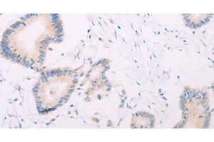 Immunohistochemistry of paraffin-embedded Human colon cancer tissue using MAP3K12 Polyclonal Antibody at dilution 1:30 (MAP3K12 Antikörper)
