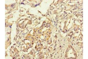 Immunohistochemistry of paraffin-embedded human pancreatic cancer using ABIN7167005 at dilution of 1:100 (KIAA1432 (KIAA1432) (AA 951-1233) Antikörper)