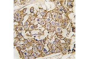 IHC analysis of FFPE human breast carcinoma tissue stained with ErbB2 antibody