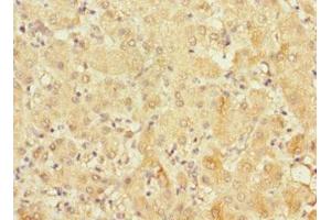 Immunohistochemistry of paraffin-embedded human liver cancer using ABIN7152685 at dilution of 1:100 (FRMD6 Antikörper  (AA 413-622))