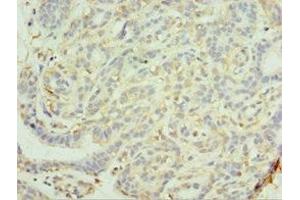 Immunohistochemistry of paraffin-embedded human breast cancer using ABIN7159289 at dilution of 1:100 (MAGEC2 Antikörper  (AA 1-150))