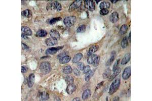 Immunohistochemistry of paraffin-embedded human breast carcinoma using Phospho-SRC-Y529 antibody (ABIN5969948). (Src Antikörper  (pTyr529))