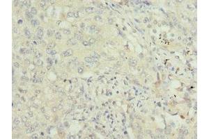 Immunohistochemistry of paraffin-embedded human lung cancer using ABIN7172240 at dilution of 1:100 (TRAF4 Antikörper  (AA 251-470))