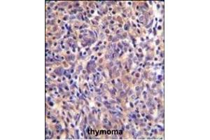 THEMIS Antibody (C-term) (ABIN655135 and ABIN2844761) immunohistochemistry analysis in formalin fixed and paraffin embedded human thymoma followed by peroxidase conjugation of the secondary antibody and DAB staining.