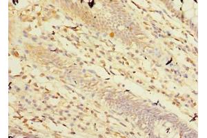 Immunohistochemistry of paraffin-embedded human colon cancer using ABIN7146760 at dilution of 1:100 (Carboxypeptidase A2 Antikörper  (AA 115-419))