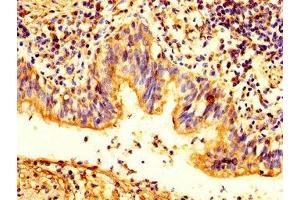IHC image of ABIN7163503 diluted at 1:200 and staining in paraffin-embedded human lung cancer performed on a Leica BondTM system. (Plakophilin 2 Antikörper  (AA 61-183))