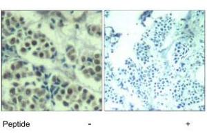 Immunohistochemical analysis of paraffin-embedded human breast carcinoma tissue using MDM2 polyclonal antibody . (MDM2 Antikörper  (Ser166))