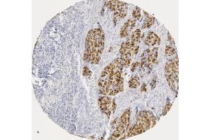 p53 staining in human squamous cell carcinoma (image courtesy of J. (p53 Antikörper  (AA 20-31))
