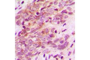 Immunohistochemical analysis of MAGEA9 staining in human breast cancer formalin fixed paraffin embedded tissue section.