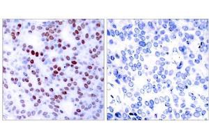 Immunohistochemical analysis of paraffin-embedded human breast carcinoma tissue using c-Jun (Ab-243) antibody (E021025). (C-JUN Antikörper)