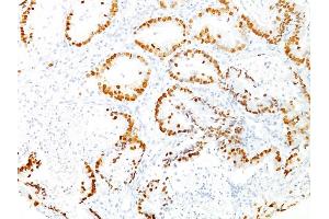 Formalin-fixed, paraffin-embedded human Lung Adenocarcinoma stained with TTF-1 Mouse Monoclonal Antibody (8G7G3/1). (NKX2-1 Antikörper)