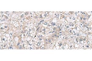 Immunohistochemistry of paraffin-embedded Human liver cancer tissue using RNF208 Polyclonal Antibody at dilution of 1:65(x200) (RNF208 Antikörper)
