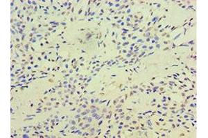 Immunohistochemistry of paraffin-embedded human breast cancer using ABIN7171737 at dilution of 1:100 (RAP1 Antikörper  (AA 1-280))