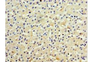Immunohistochemistry of paraffin-embedded human liver cancer using ABIN7156612 at dilution of 1:100