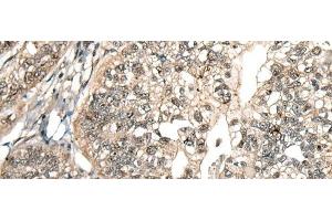 Immunohistochemistry of paraffin-embedded Human gastric cancer tissue using MCPH1 Polyclonal Antibody at dilution of 1:110(x200)