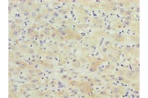 Immunohistochemistry of paraffin-embedded human liver cancer using ABIN7145848 at dilution of 1:100 (KCTD19 Antikörper  (AA 490-751))