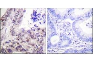 Immunohistochemistry analysis of paraffin-embedded human colon carcinoma, using Caspase 9 (Phospho-Ser144) Antibody. (Caspase 9 Antikörper  (pSer144))