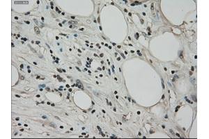 Immunohistochemical staining of paraffin-embedded Adenocarcinoma of ovary tissue using anti-BUB1Bmouse monoclonal antibody. (BUB1B Antikörper)