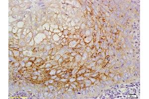 Formalin-fixed and paraffin embedded human laryngeal cancer labeled with Anti-CD44v5 Polyclonal Antibody, Unconjugated  at 1:200 followed by conjugation to the secondary antibody (CD44RC (AA 61-139) Antikörper)