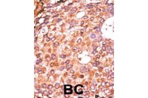 Formalin-fixed and paraffin-embedded human cancer tissue reacted with E2F1 (phospho S337) polyclonal antibody  which was peroxidase-conjugated to the secondary antibody followed by AEC staining. (E2F1 Antikörper  (pSer337))