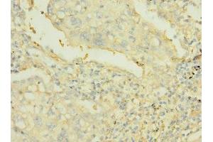 Immunohistochemistry of paraffin-embedded human lung cancer using ABIN7167504 at dilution of 1:100 (PTPRJ Antikörper  (AA 140-370))