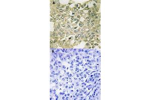 Immunohistochemical staining of human breast carcinoma tissue by PKMYT1 (phospho S83) polyclonal antibody  without blocking peptide (A) or preincubated with blocking peptide (B) under 1:50-1:100 dilution. (PKMYT1 Antikörper  (pSer83))